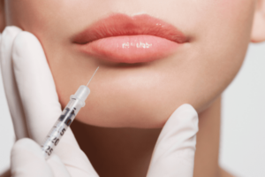 Woman with full lips getting lip fillers for added volume - Derma Medica